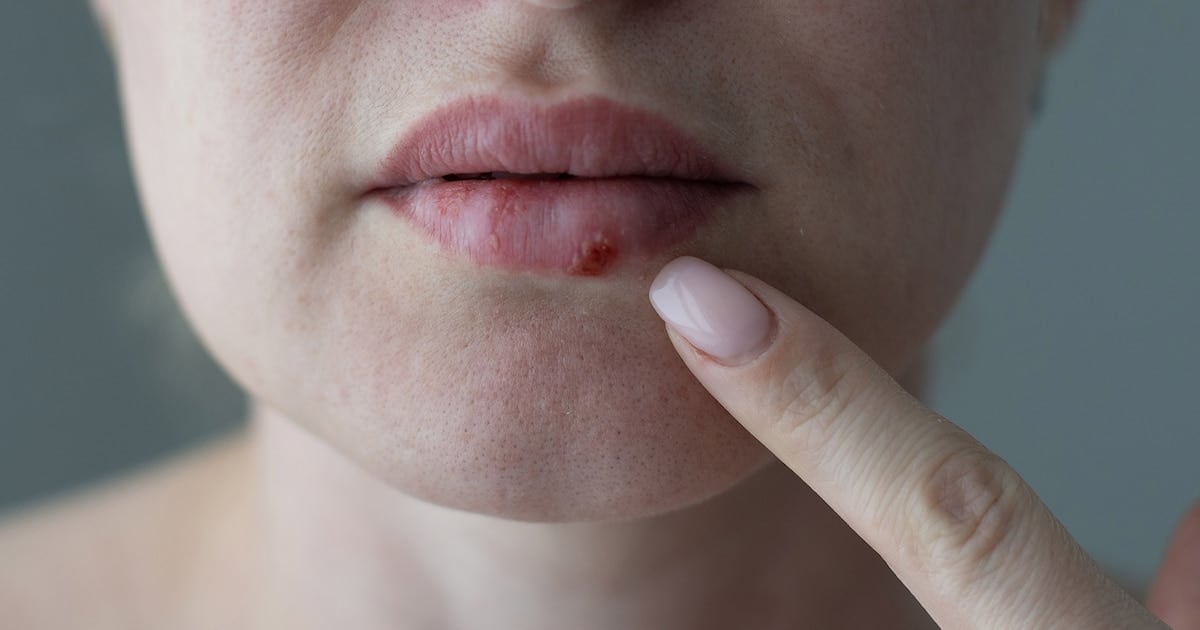 La FDA aprobó el pritelivir, el primer antiviral oral en casi treinta años para herpes simple resistente