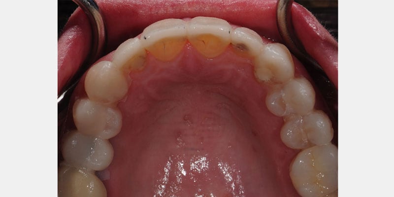 Carillas dentales: las señales de una filtración que pueden exigir reparación